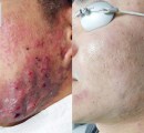 Before and after results of acne treatment on male patient.