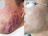 Before and after results of acne treatment on male patient.