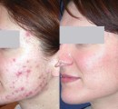 Results of laser acne treatment on young female patient.