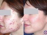 Results of laser acne treatment on young female patient.