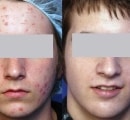 Results of acne treatment on male patient.