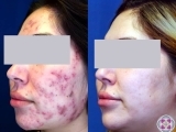 Laser treatment for active acne