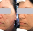acne treatment with lasers