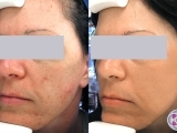 acne treatment with lasers