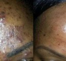 Laser acne removal