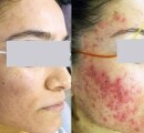 Before and after of laser acne treatment on female patient.