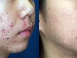 Before and after of laser acne treatment on female patient.