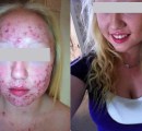 Laser acne treatment before and after on a teenage girl..