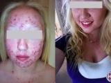 Laser acne treatment before and after on a teenage girl..