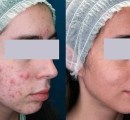 Before and after laser acne treatment on a female patient.
