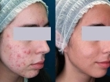 Before and after laser acne treatment on a female patient.