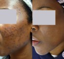 Before and after results of laser treatment for acne on dark skin.