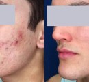 Before and after laser cystic acne treatment on a male patient.