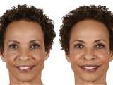 juvederm-filler-patient-before-and-after-results-female-3-copy