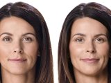 juvederm-filler-patient-before-and-after-results-female-5-copy