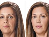 juvederm-filler-patient-before-and-after-results-female-6-copy
