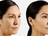 juvederm-filler-patient-before-and-after-results-female-copy