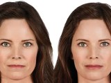 juvederm-filler-patient-before-and-after-results-female2-copy