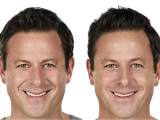 juvederm-filler-patient-before-and-after-results-male-copy