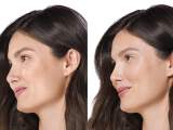juvederm-filler-results-patient-before-and-after-treatment-female-7-copy