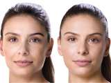 juvederm-filler-results-patient-before-and-after-treatment-female-8-copy