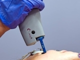 Laser vein removal pulsed dye laser