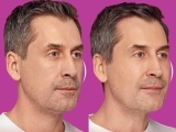 restylane-before-and-after-filler-6