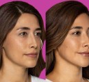 restylane-before-and-after-filler-7