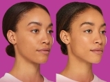 restylane-before-and-after-filler-8
