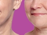 restylane-before-and-after-filler
