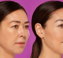 restylane-filler-before-and-after