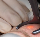 The CO2 laser helps build collagen to keep the rosacea away