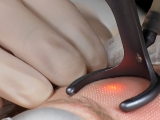 The CO2 laser helps build collagen to keep the rosacea away