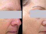 Laser rosacea treatment before and after