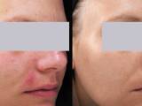 Acne rosacea before and after treatment.