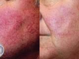 Before and After Laser Treatment for Rosacea