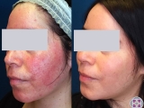 Rosacea on the cheeks completely removed with laser treatment.