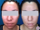 Laser Treatment to Remove Redness on the Face