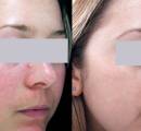 Redness of the cheeks treatment