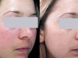 Laser treatment for rosacea on the cheeks.