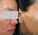 rosacea seborrheic dermatitis face dark skin