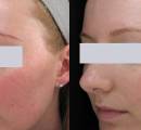Before and After Laser Treatment to Get Rid of Rosacea
