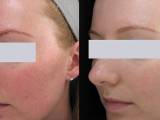 Redness, spider veins, rosacea, can all be removed with various lasers.
