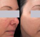 Rosacea treatment before and after