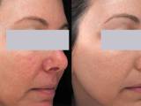 Rosacea treatment before and after laser light therapy