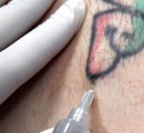 Painless Tattoo Removal