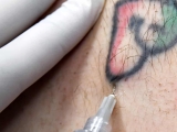 Painless Tattoo Removal