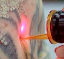 Q-switch laser tattoo removal